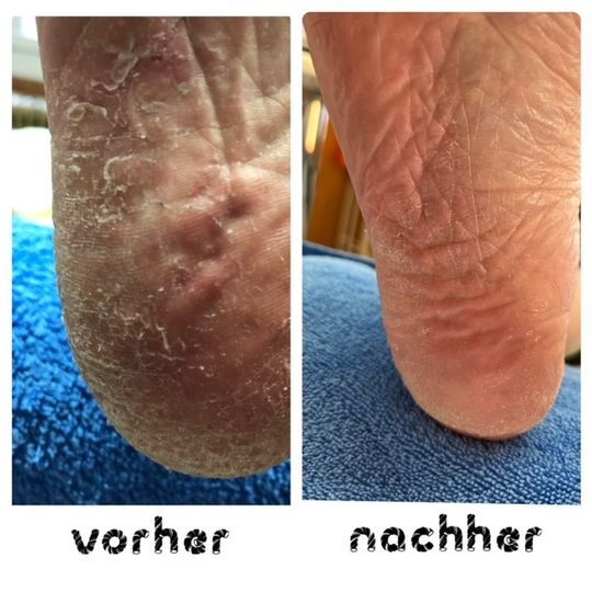 Lackierte Zehennägel - Fusspflegestudio