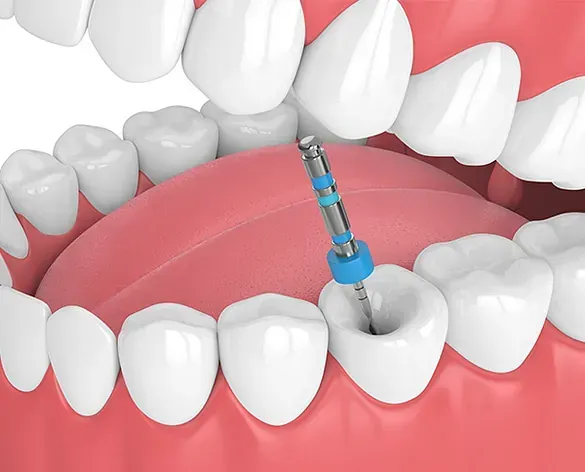 Un primer plano de los dientes de una persona con un taladro dental en él.