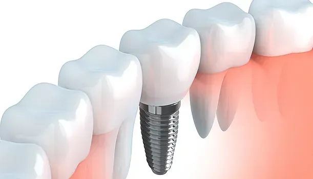 Un primer plano de un diente con un implante dental.