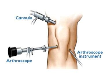 Αρθροσκόπηση