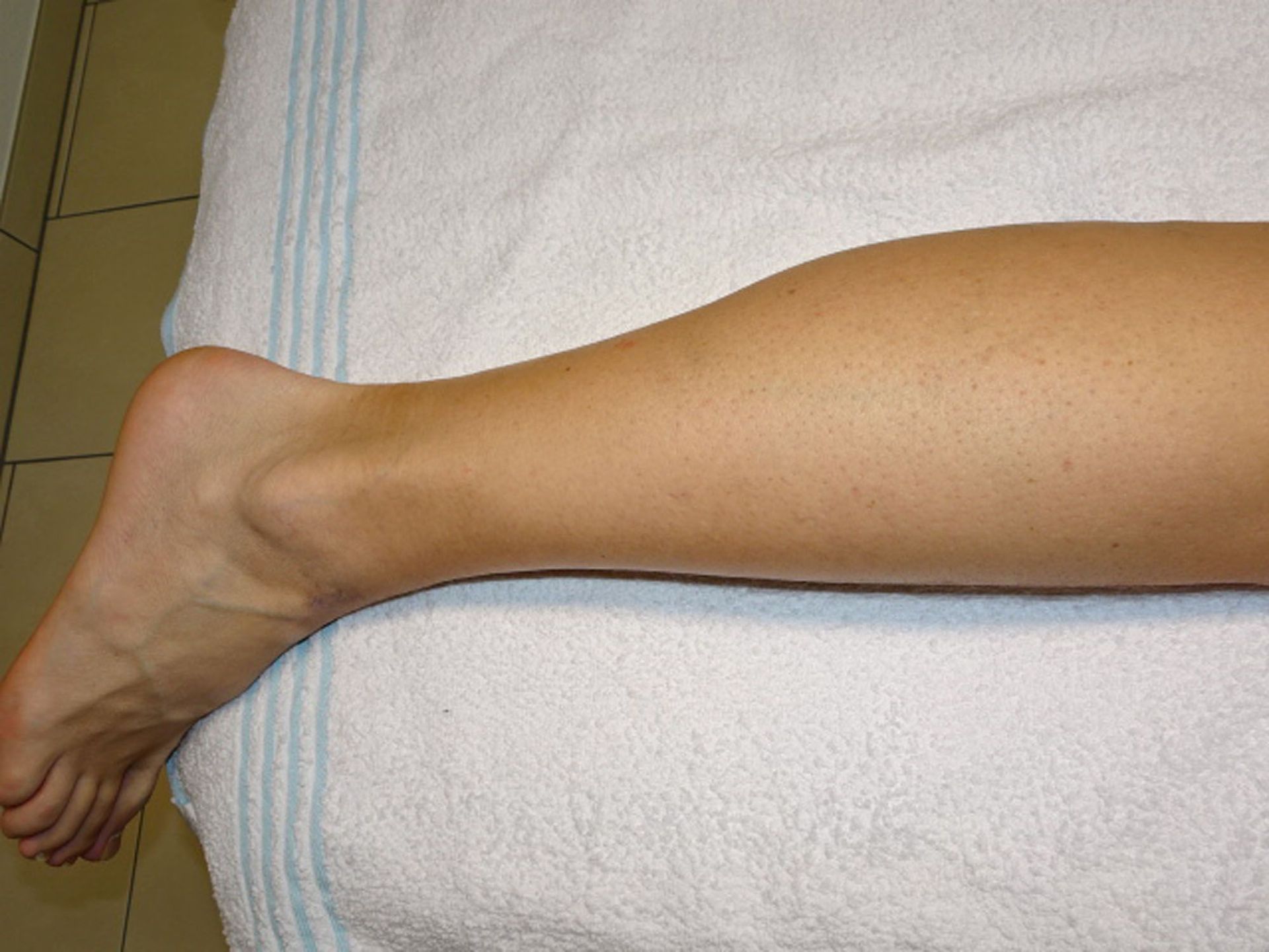 Dauerhafte Haarentfernung - Haarentfernung Zürcher Unterland - Winkel ZH