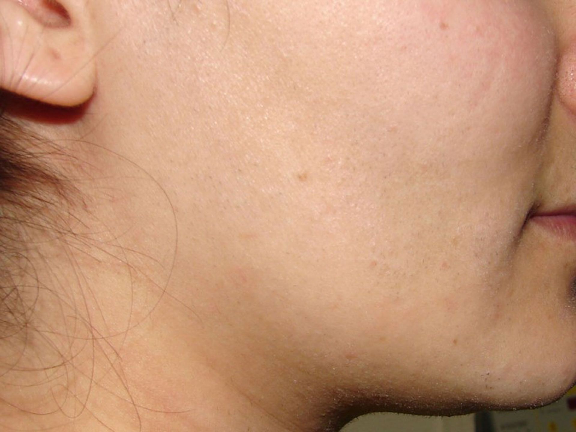 Dauerhafte Haarentfernung - Haarentfernung Zürcher Unterland - Winkel ZH