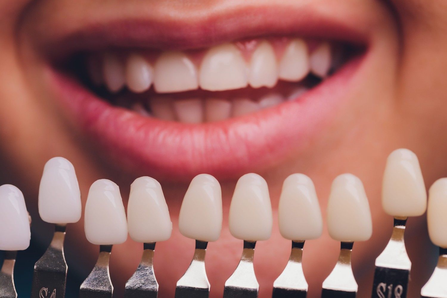 Una persona sonríe mostrando sus dientes naturales junto a una guía de colores dentales
