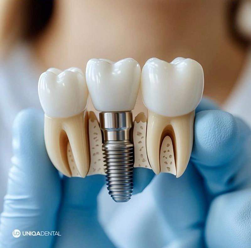 Implante dental con tres coronas blancas en una mano enguantada de azul, modelo dental en primer plano.