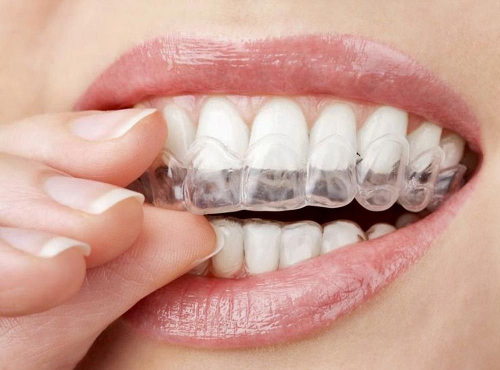 Manos retirando un alineador transparente de los dientes, mostrando una sonrisa en primer plano.