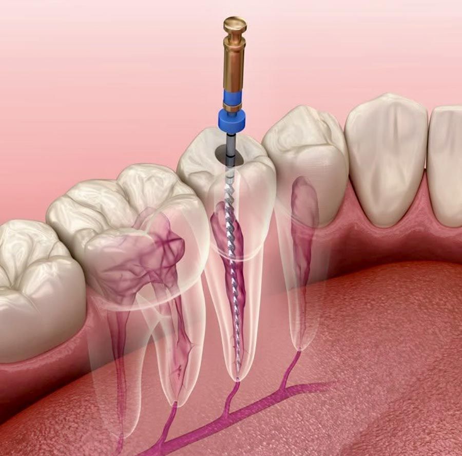 Ilustración de un tratamiento de conducto radicular dental con el instrumento dentro de un diente y molares adyacentes.