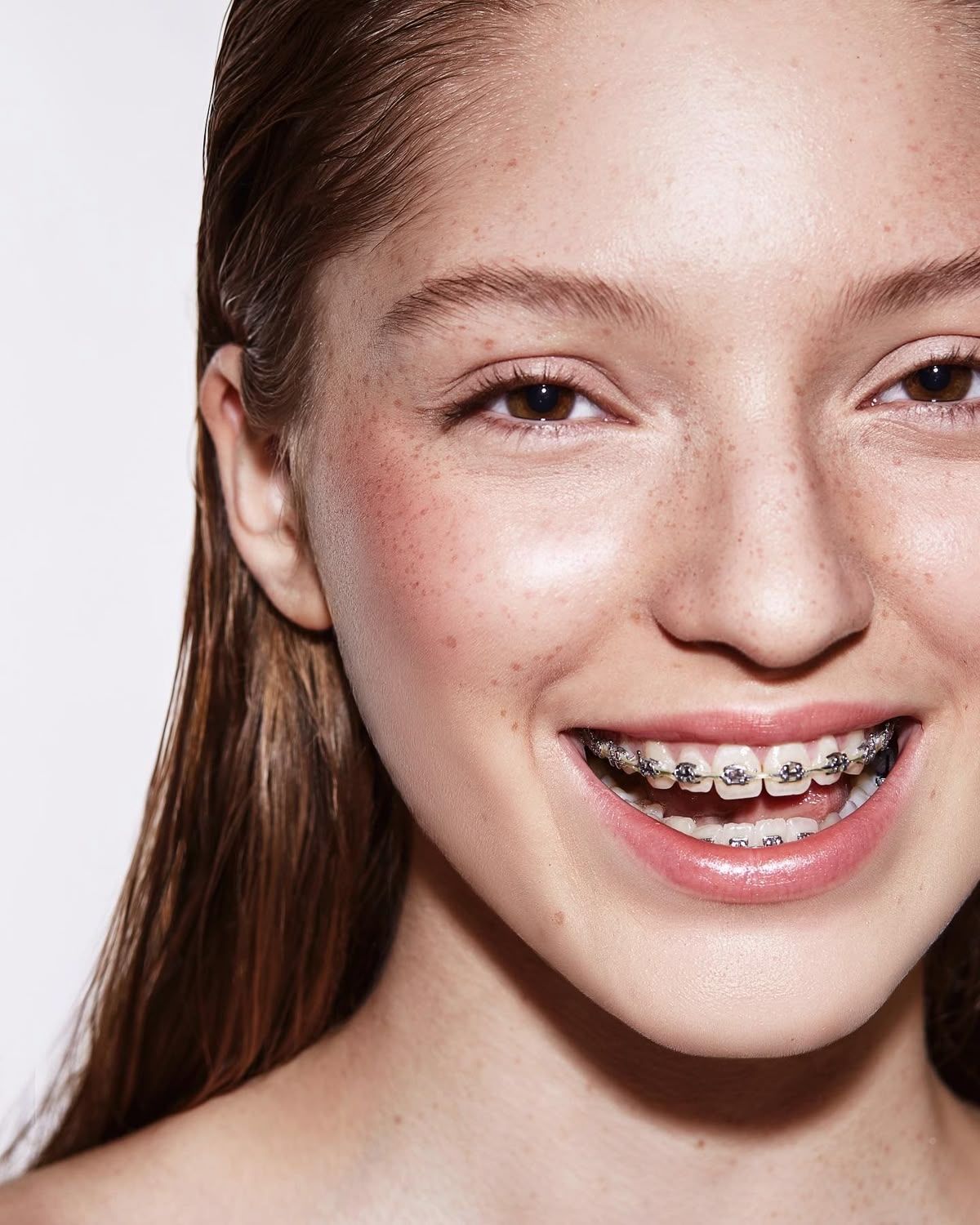 Niña con brackets sonriendo, primer plano. Piel clara, pecas, mejillas rosadas, sobre fondo blanco.