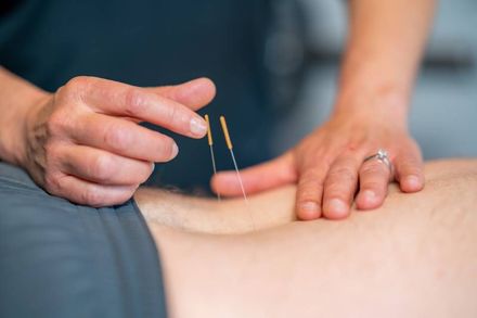 Akupunktur Dry Needling