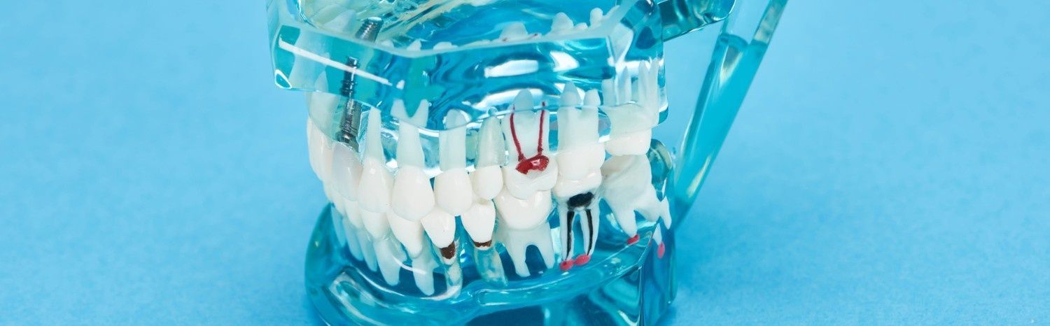 Modelo dental transparente con dientes blancos y aparatos de ortodoncia sobre un fondo azul.