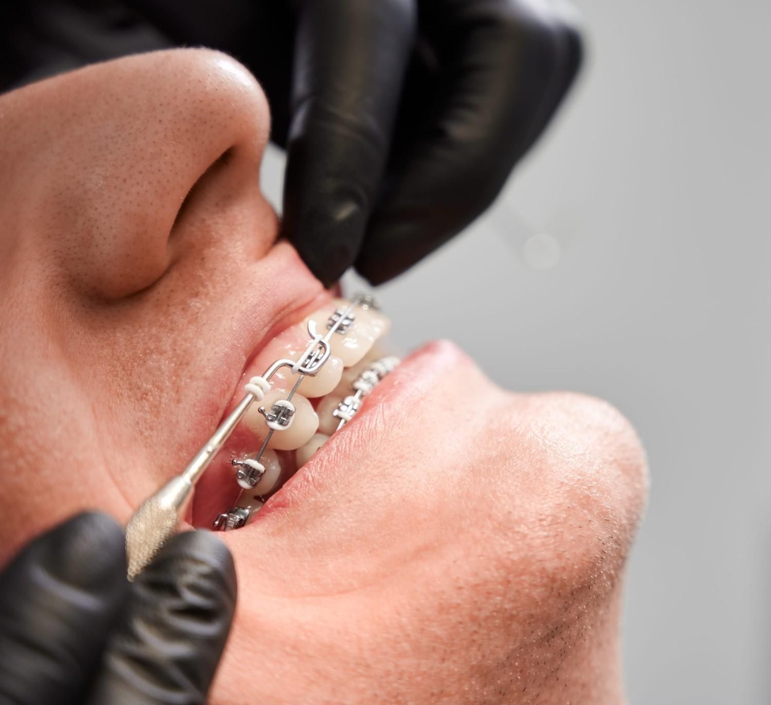 Primer plano de un dentista ajustando los aparatos de ortodoncia de un paciente con las manos enguantadas.