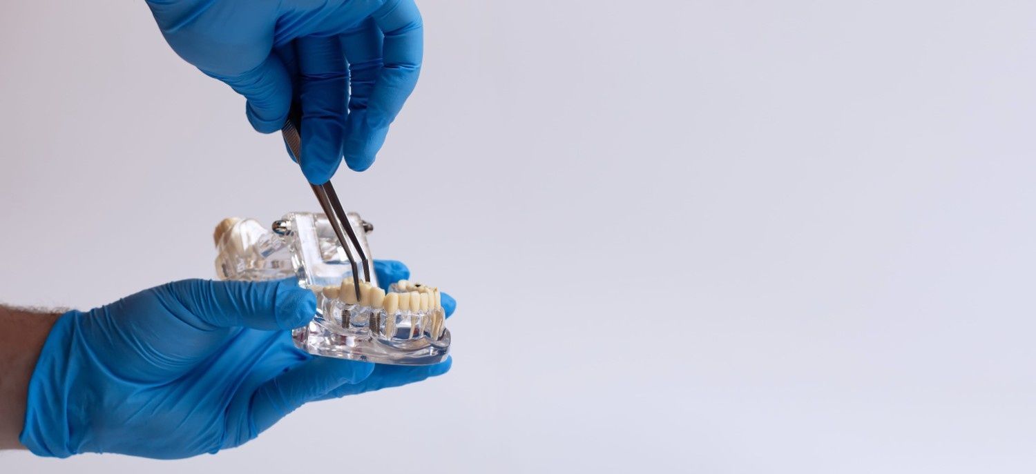 Manos enguantadas de azul utilizando pinzas en un pequeño molde dental con un soporte metálico.