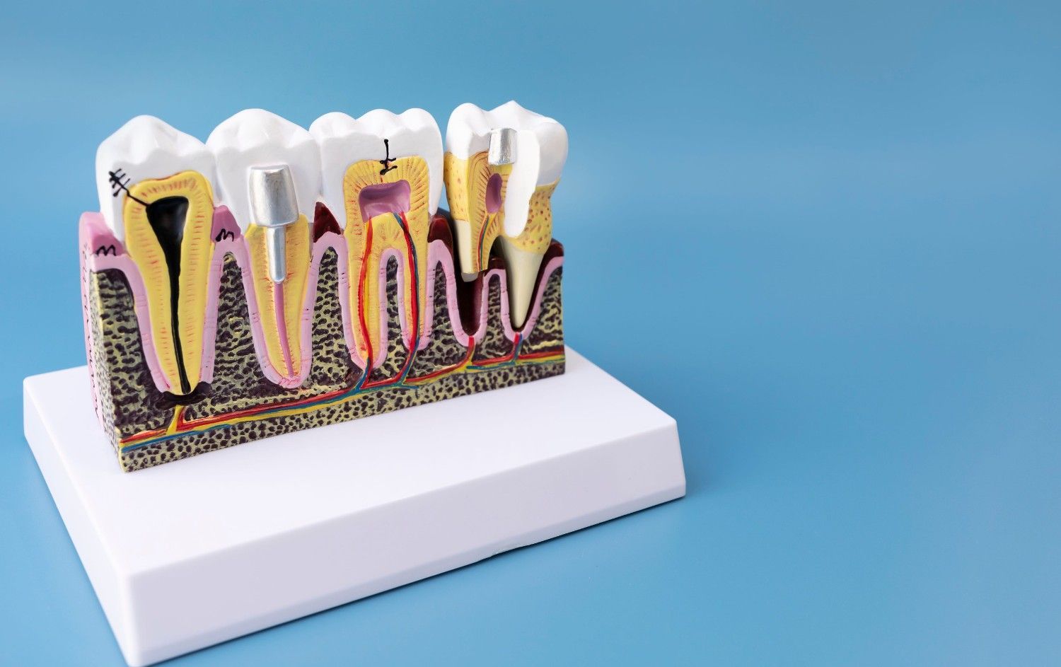 Modelo anatómico dental que muestra una sección transversal de los dientes y las encías sobre una base blanca.