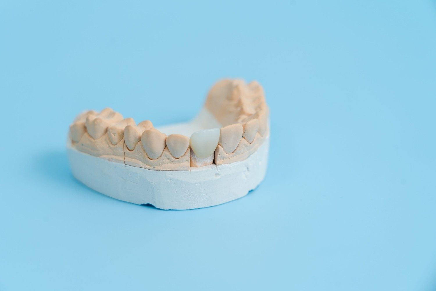Modelo de molde dental sobre un fondo azul claro