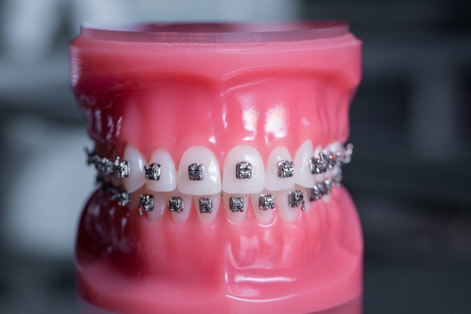Modelo dental rosa con aparatos de metal en los dientes superiores e inferiores.