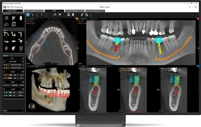 Dos dientes blancos sobre un fondo azul claro, uno de ellos con un implante dental plateado enraizado debajo.