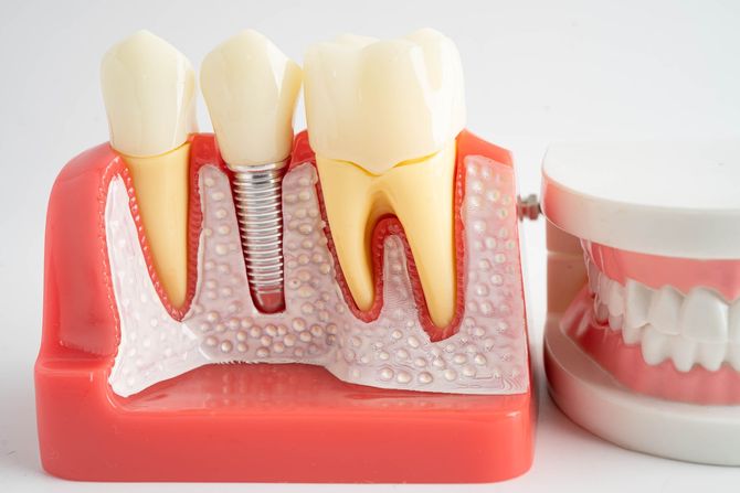 Modelo dental que muestra las encías, los dientes y un implante junto a una prótesis dental removible.