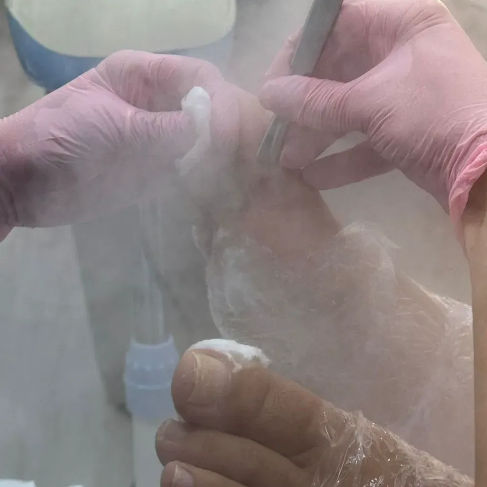 El pie de una persona es tratado con una herramienta. Las manos, con guantes rosas, aplican algo, posiblemente vapor o niebla.