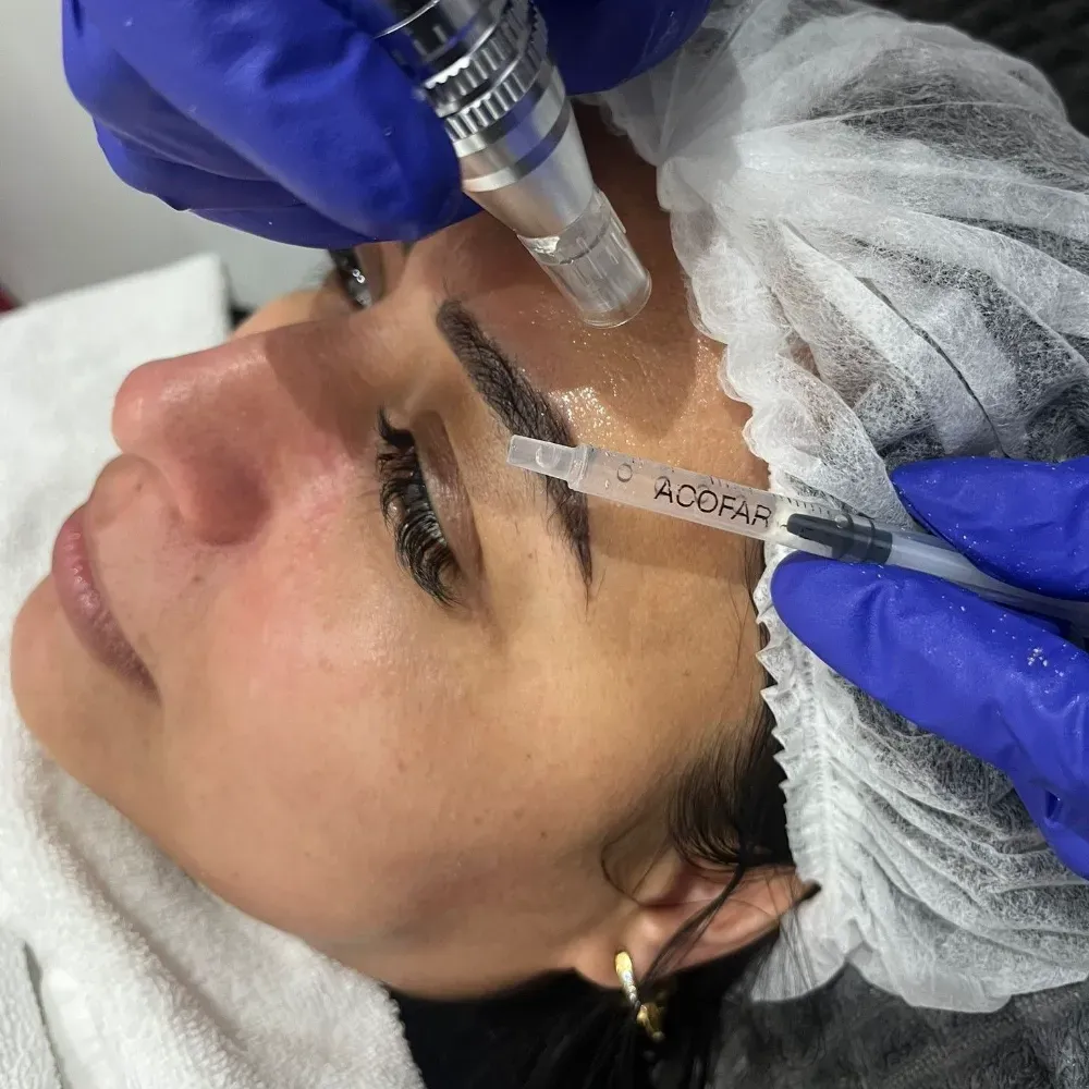 Persona que recibe un procedimiento cosmético en la cara; se utilizan agujas y dispositivos de microagujas.