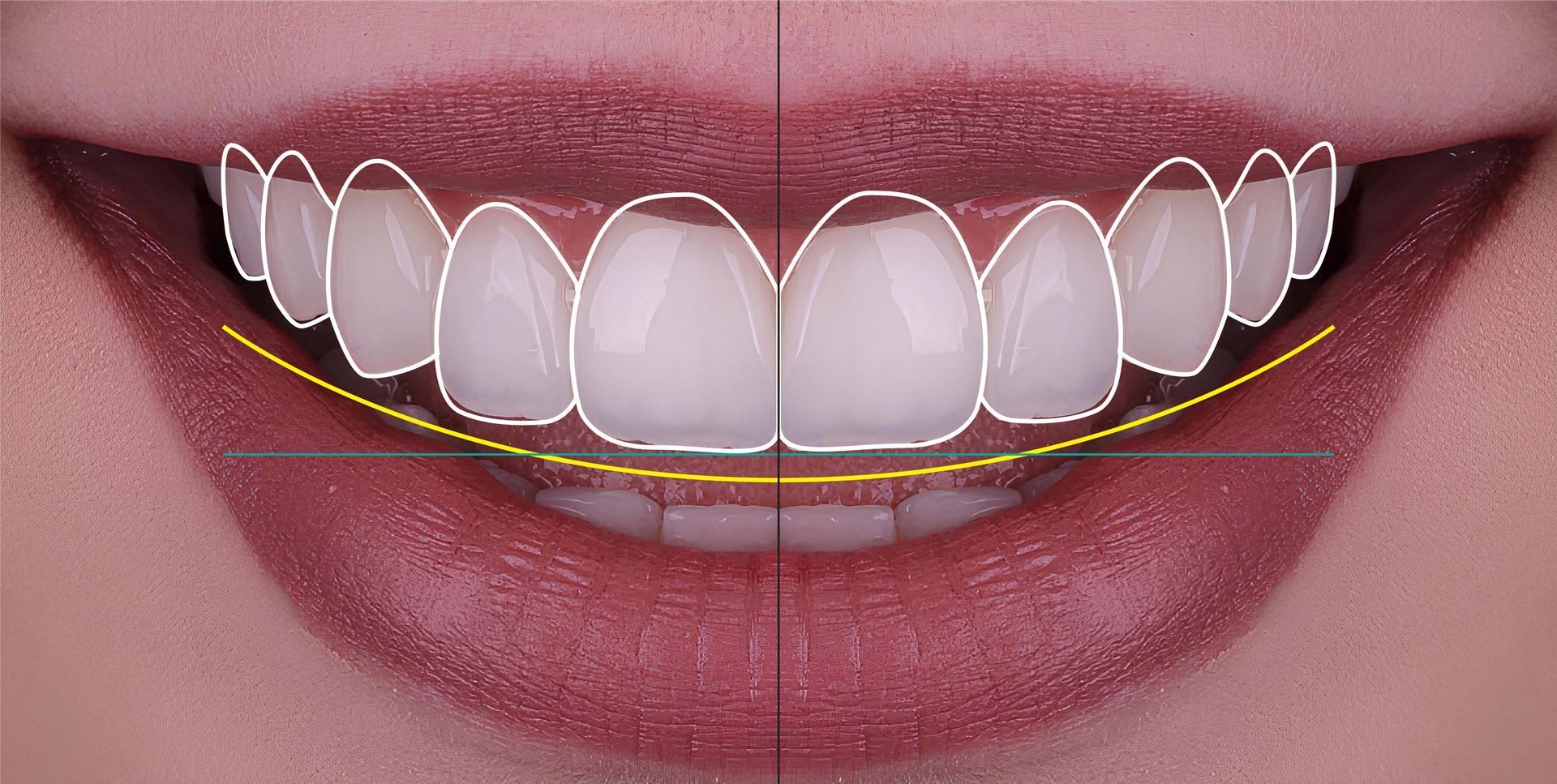 Bouche aux dents blanches soulignées par un guide d'alignement dentaire, affichant un sourire