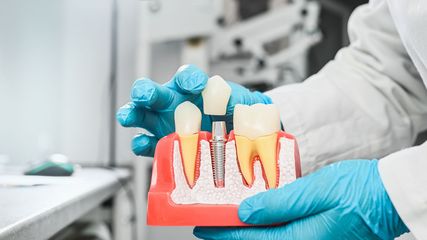 Mains gantées tenant un modèle d'implant dentaire avec dents et racines dans un environnement clinique