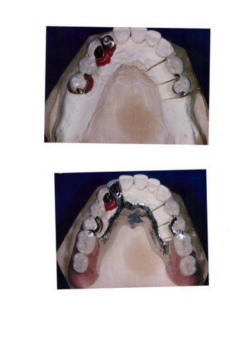 Vollprothese - Pavlodent Zahntechnisches Labor - Baden