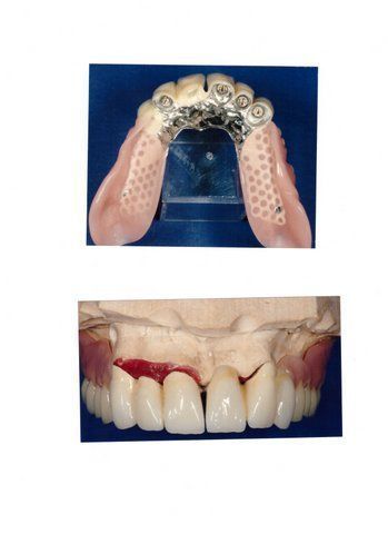 Vollprothese - Pavlodent Zahntechnisches Labor - Baden