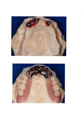 Vollprothese - Pavlodent Zahntechnisches Labor - Baden