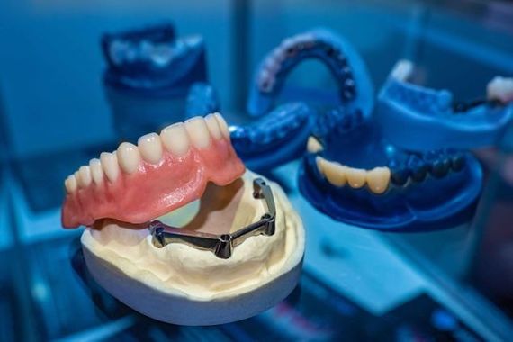 Modelli di protesi rimovibili. Protesi della cavità dentale - Studio dentistico Dr. Bressan - Grigioni