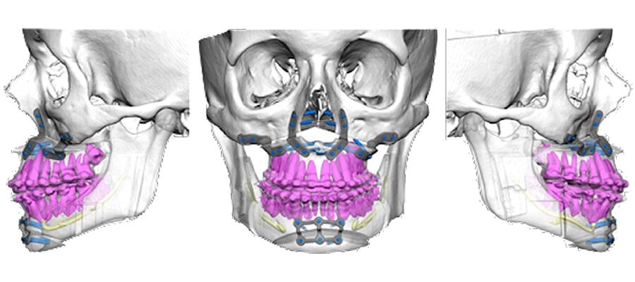 Planeamento 3D de cirurgia ortognática bimaxilar e mentoplastia com desenho de placas customizadas de fixação na maxila e mento