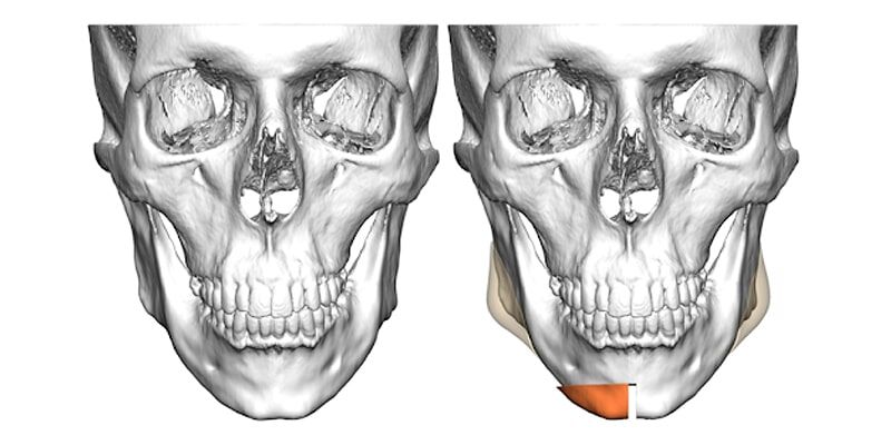 Planeamento 3D de mentoplastia com recurso a placas customizadas de fixação e próteses bilaterais de ângulos mandibulares para masculinização da face