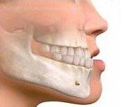 RECUO MAXILO-MANDIBULAR - CLINICA DA FACE