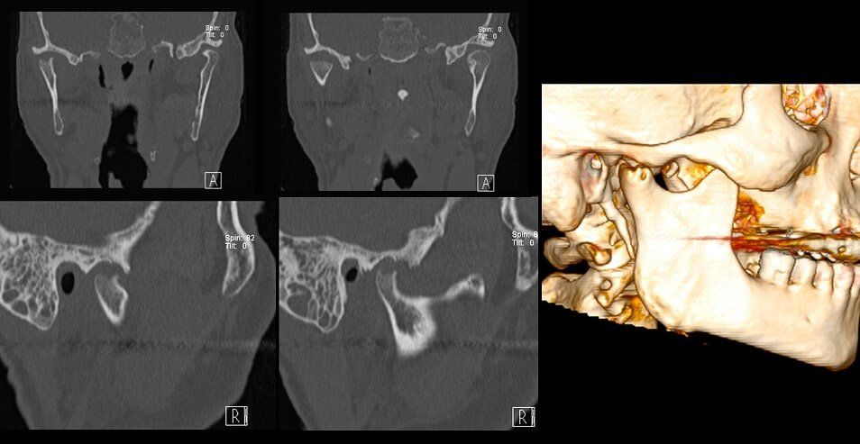Um caso raro de Artrite Séptica da Articulação Temporomandibular