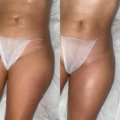 Torso antes y post tratamiento reductor