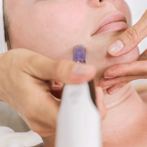 Primer plano de una persona sometida a un tratamiento facial de microagujas. Una mano sostiene un dispositivo y toca la piel.