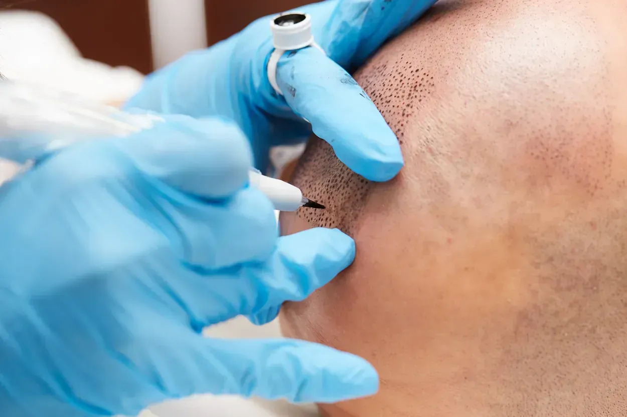 Primer plano de manos enguantadas que realizan micropigmentación del cuero cabelludo en una cabeza calva, utilizando una aguja para crear impresiones de folículos pilosos.