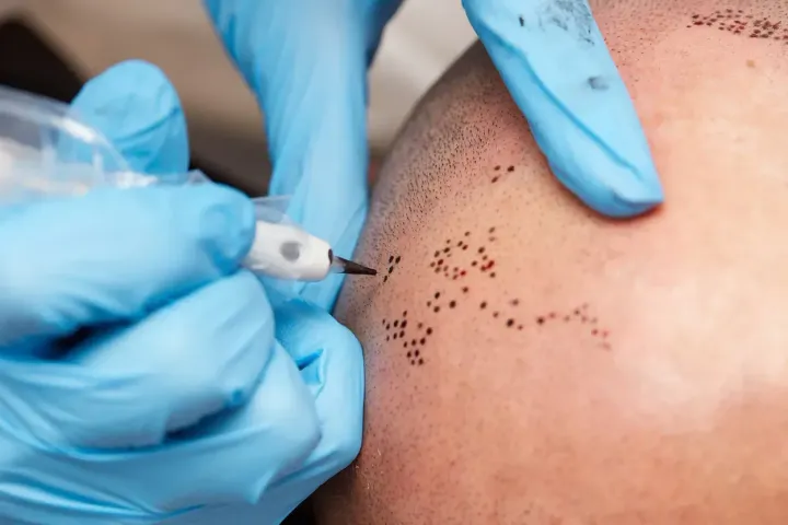 El cuero cabelludo de una persona es tatuado con pequeños puntos mediante manos enguantadas, un procedimiento conocido como micropigmentación del cuero cabelludo.