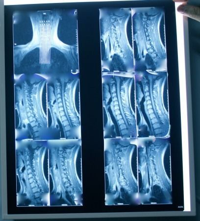 Se muestra una radiografía de la columna vertebral de una persona.