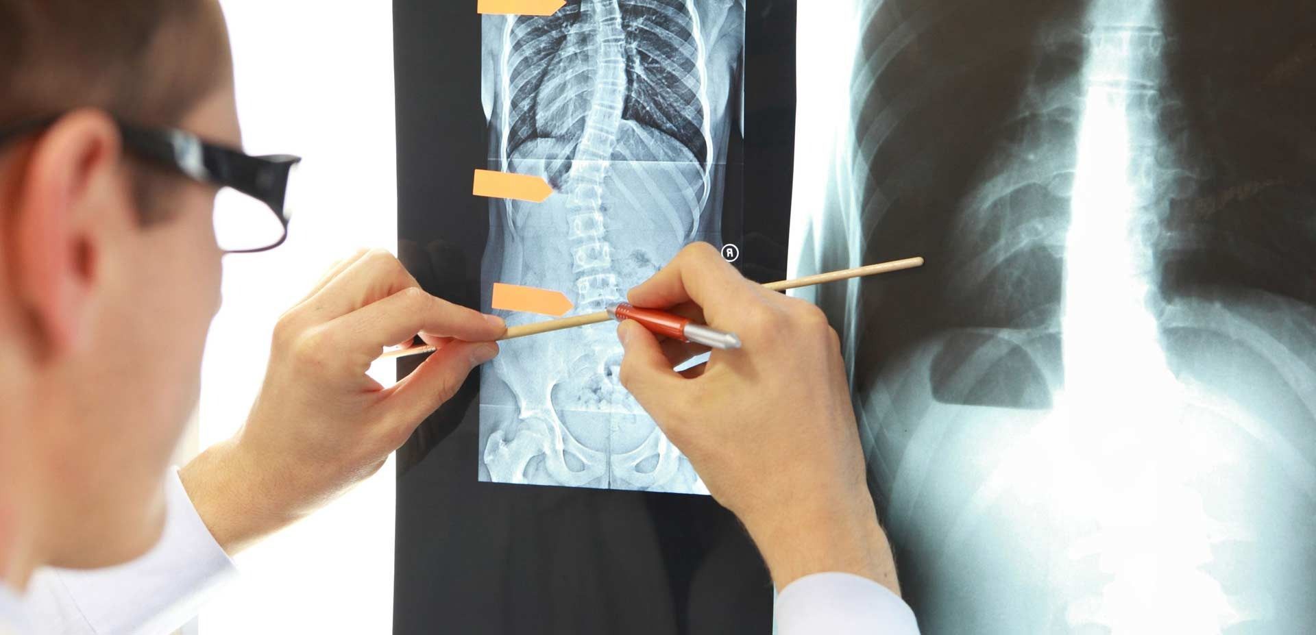 Un médico está mirando una radiografía de la columna vertebral de una persona.