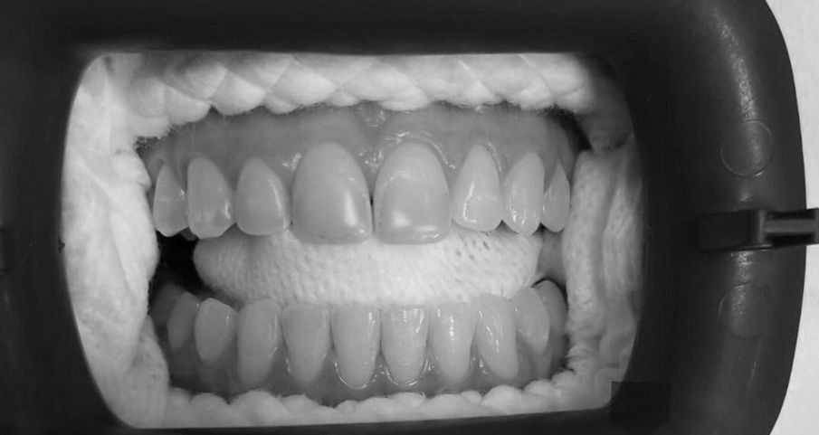 Vista de los dientes superiores e inferiores por parte del dentista, con un babero, que muestra un procedimiento dental en progreso.
