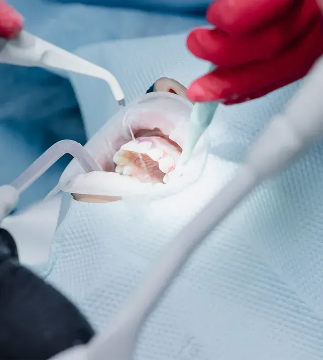 Una persona se está blanqueando los dientes con un dentista.