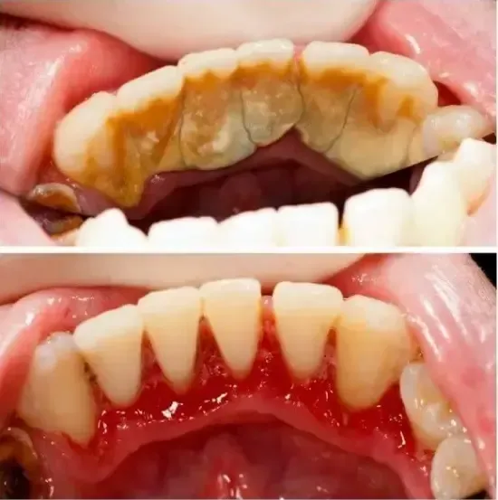  A parte superior mostra placa bacteriana e tártaro abundantes, a inferior mostra os dentes limpos.
