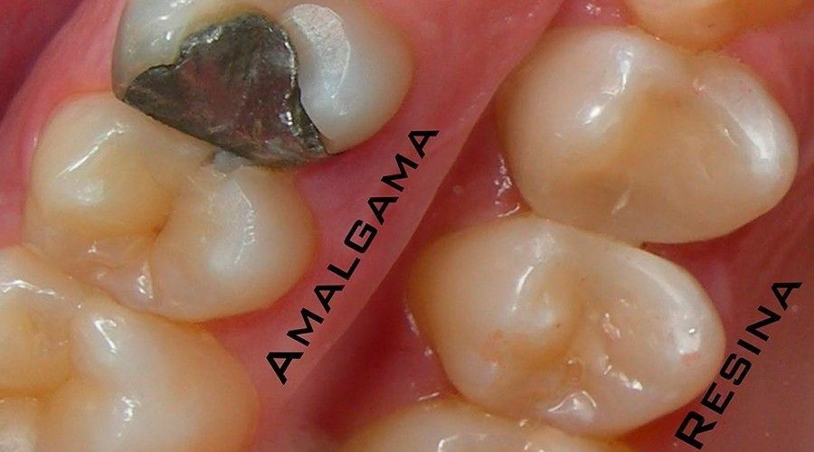 Close de dentes com obturação de amálgama e obturações de resina.