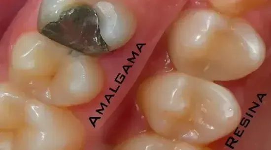 Close de dentes com obturação de amálgama e obturações de resina.