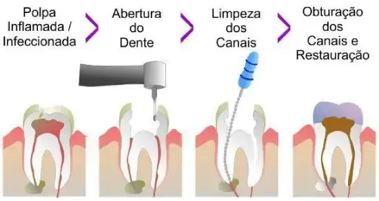 Diagrama de um procedimento de canal radicular, mostrando os estágios desde a polpa infectada até a restauração.