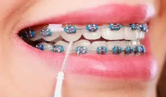 Close de dentes com aparelho, usando uma escova de limpeza. Cores azul e branco.