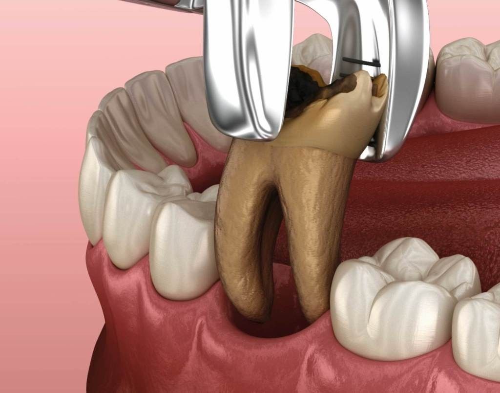 Extração dentária: alicate removendo um molar cariado da boca de um paciente.
