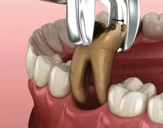 Extração dentária: alicate removendo um molar cariado da boca de um paciente.