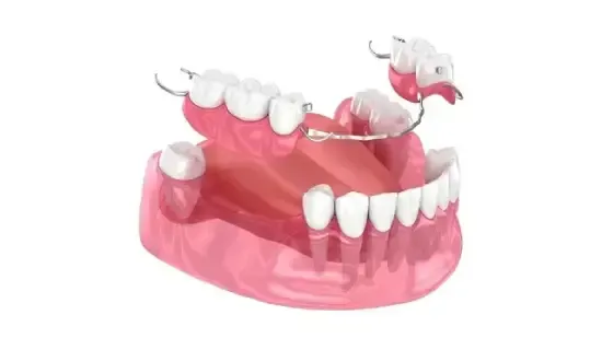 Modelo dentário mostrando uma prótese parcial no maxilar superior e uma prótese total no maxilar inferior.