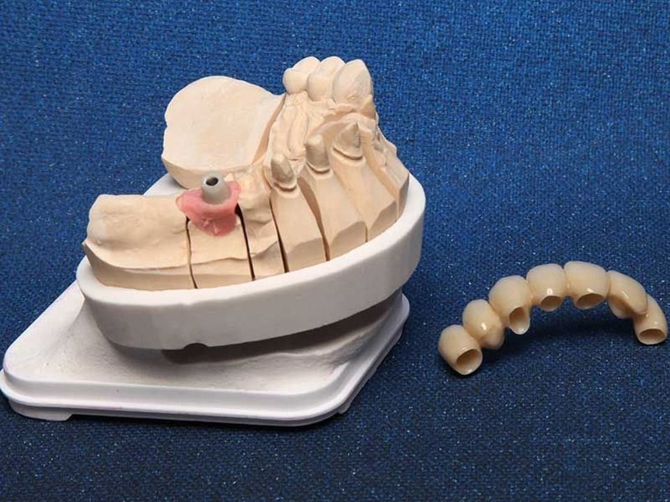 Zahnmodell einer Brücke und einer Vollprothese mit rosa Klammer auf weißem Untergrund, daneben eine Teilprothese.