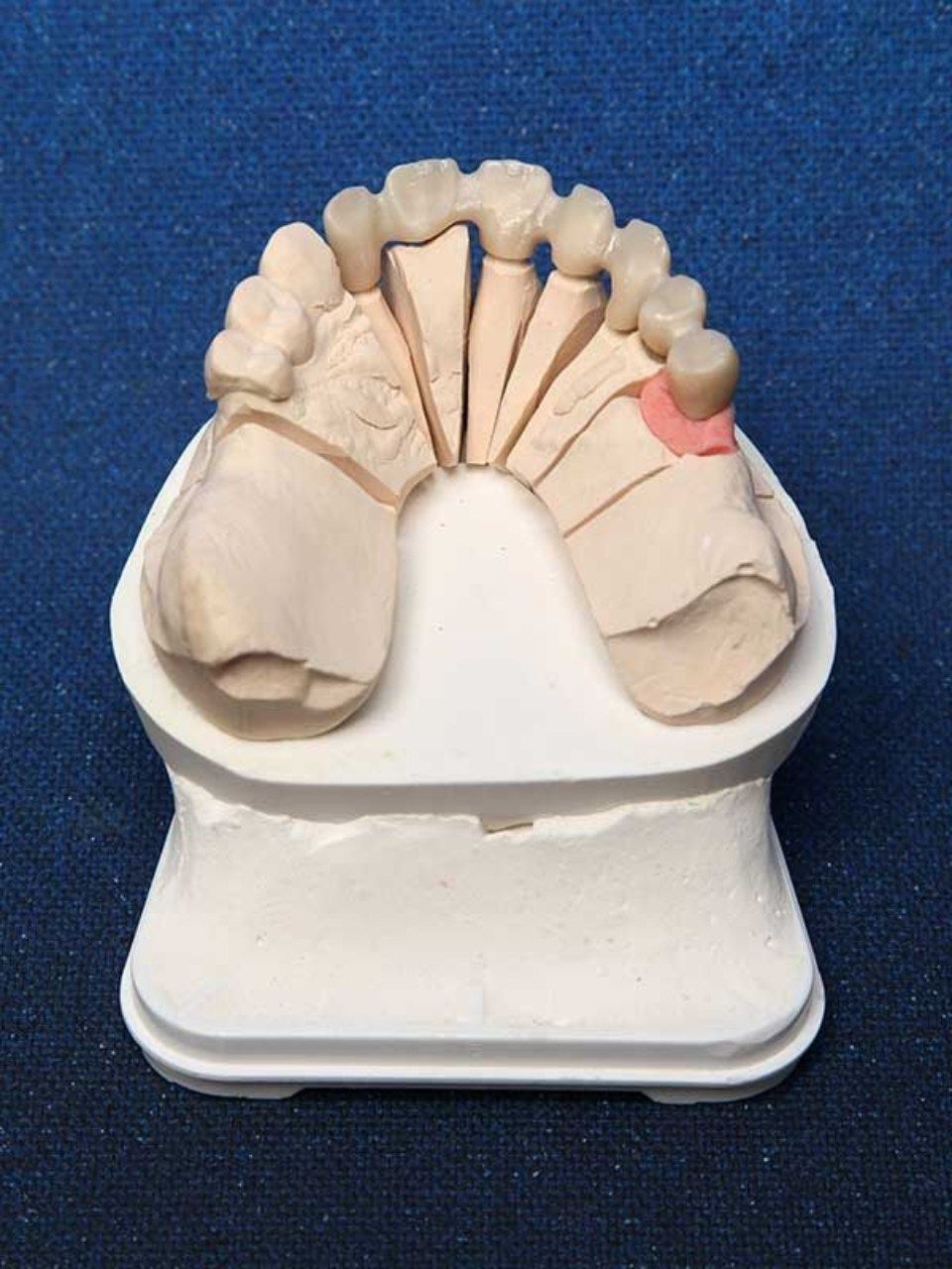 Zahnabdruck mit Abdrücken der oberen Zähne und einem rosa hervorgehobenen Zahn auf einem Ständer